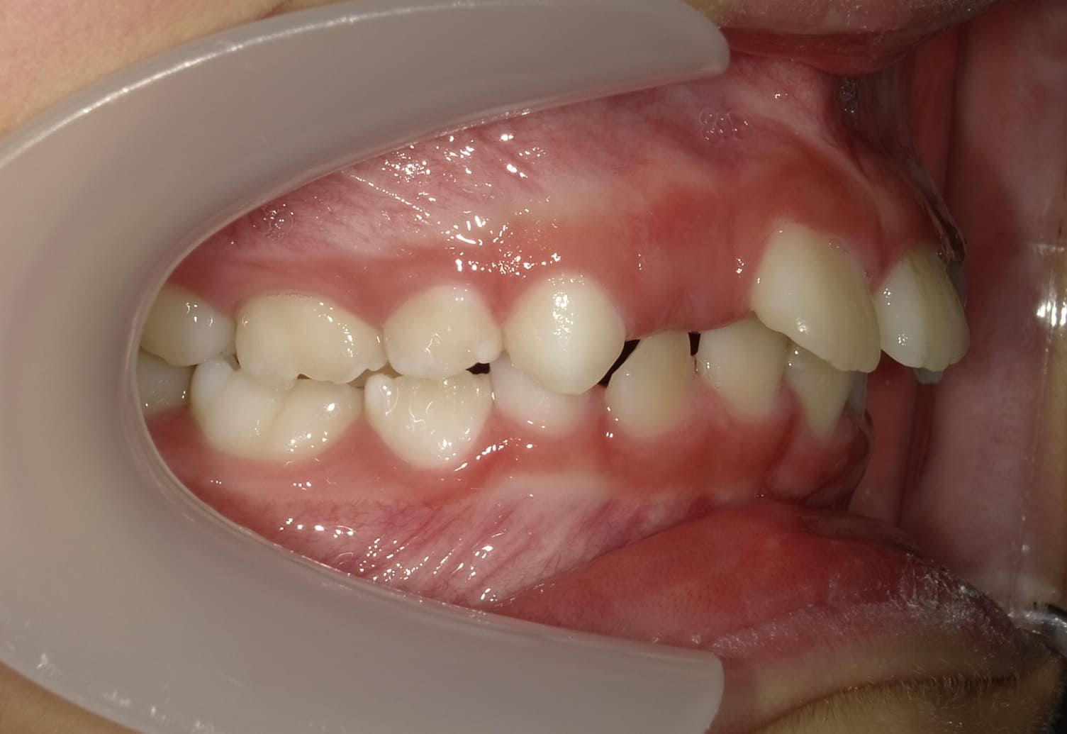 施術前の口内写真02