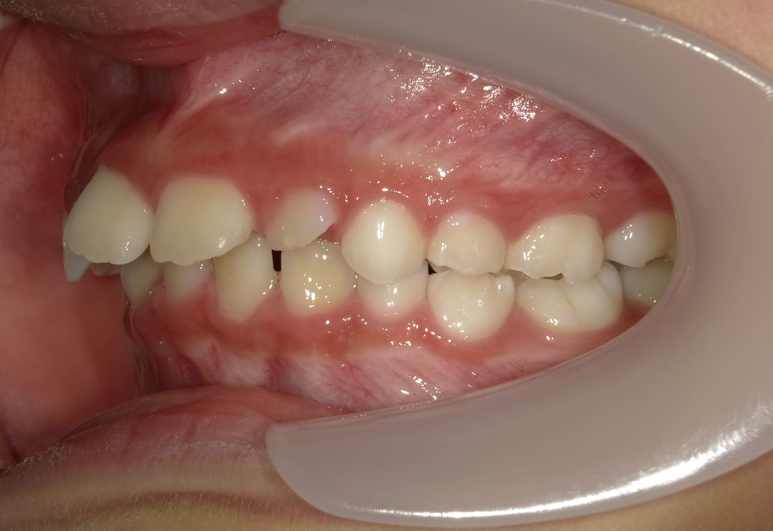 施術前の口内写真03