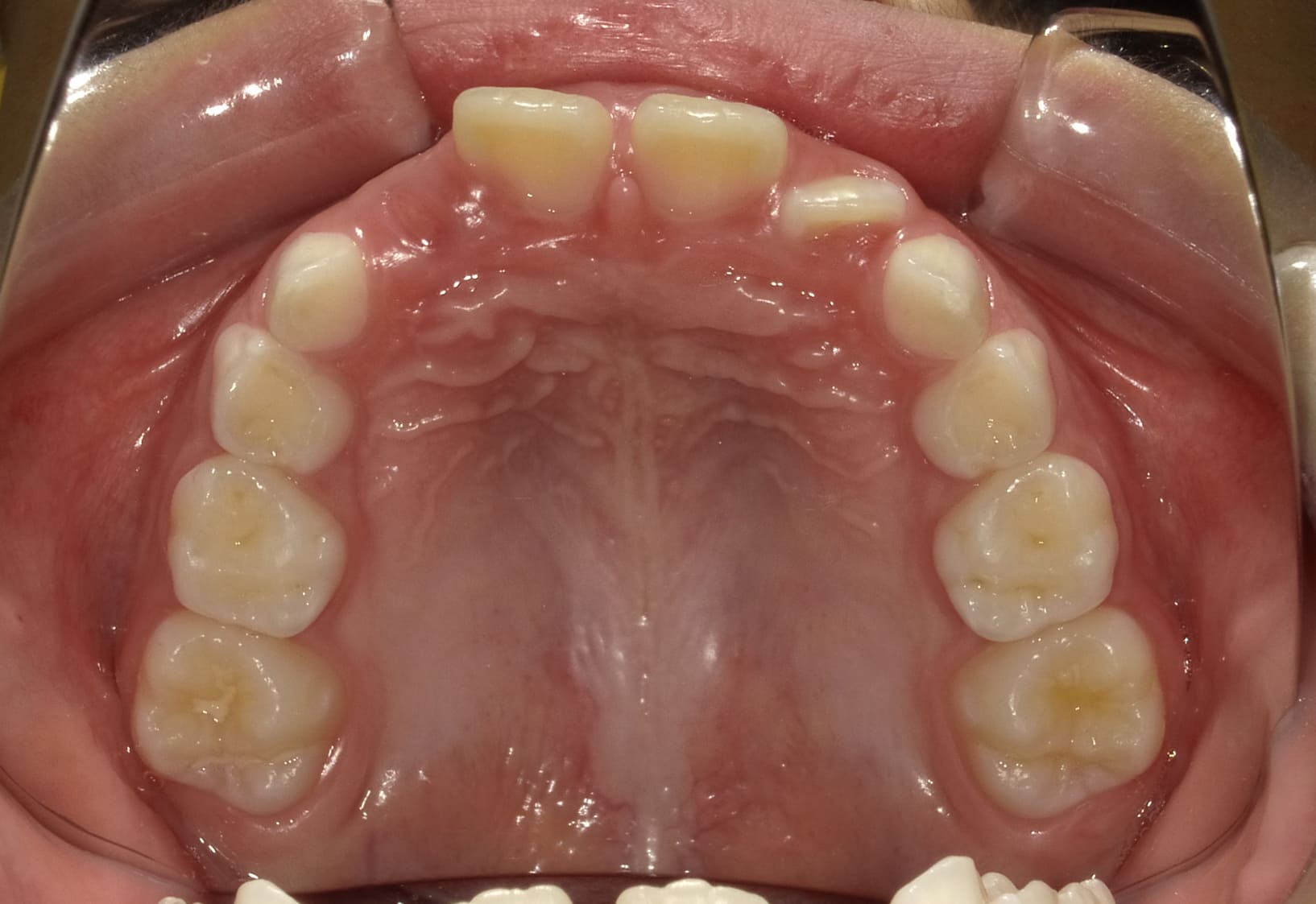 施術前の口内写真04