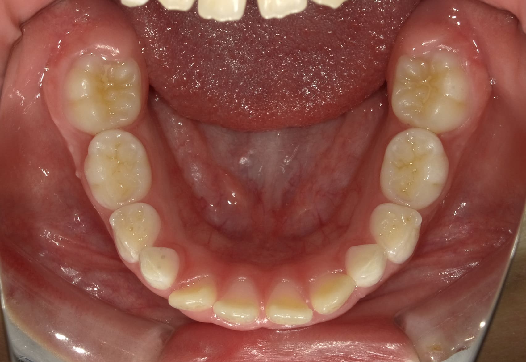 施術前の口内写真05