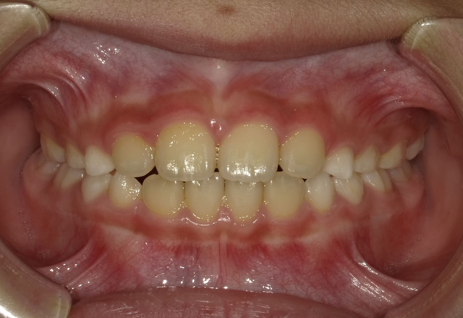 施術後の口内写真01