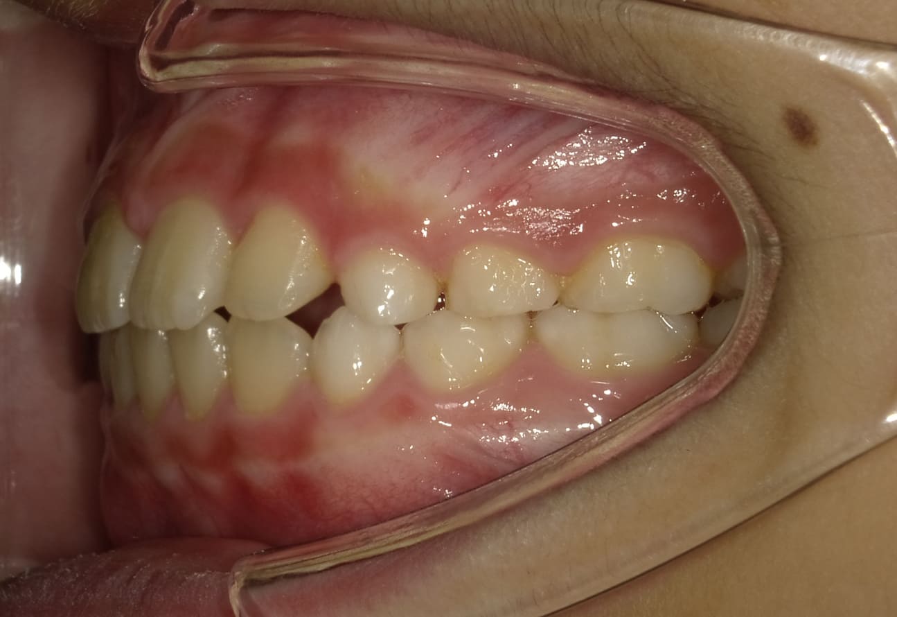 施術後の口内写真03