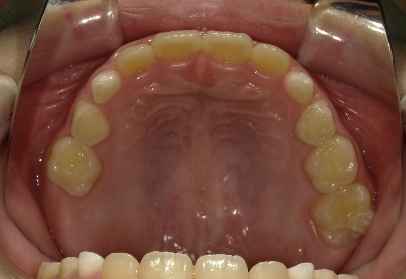 施術後の口内写真04