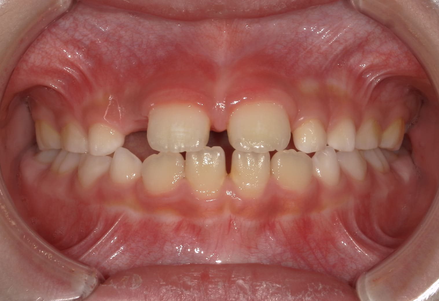 施術前の口内写真01