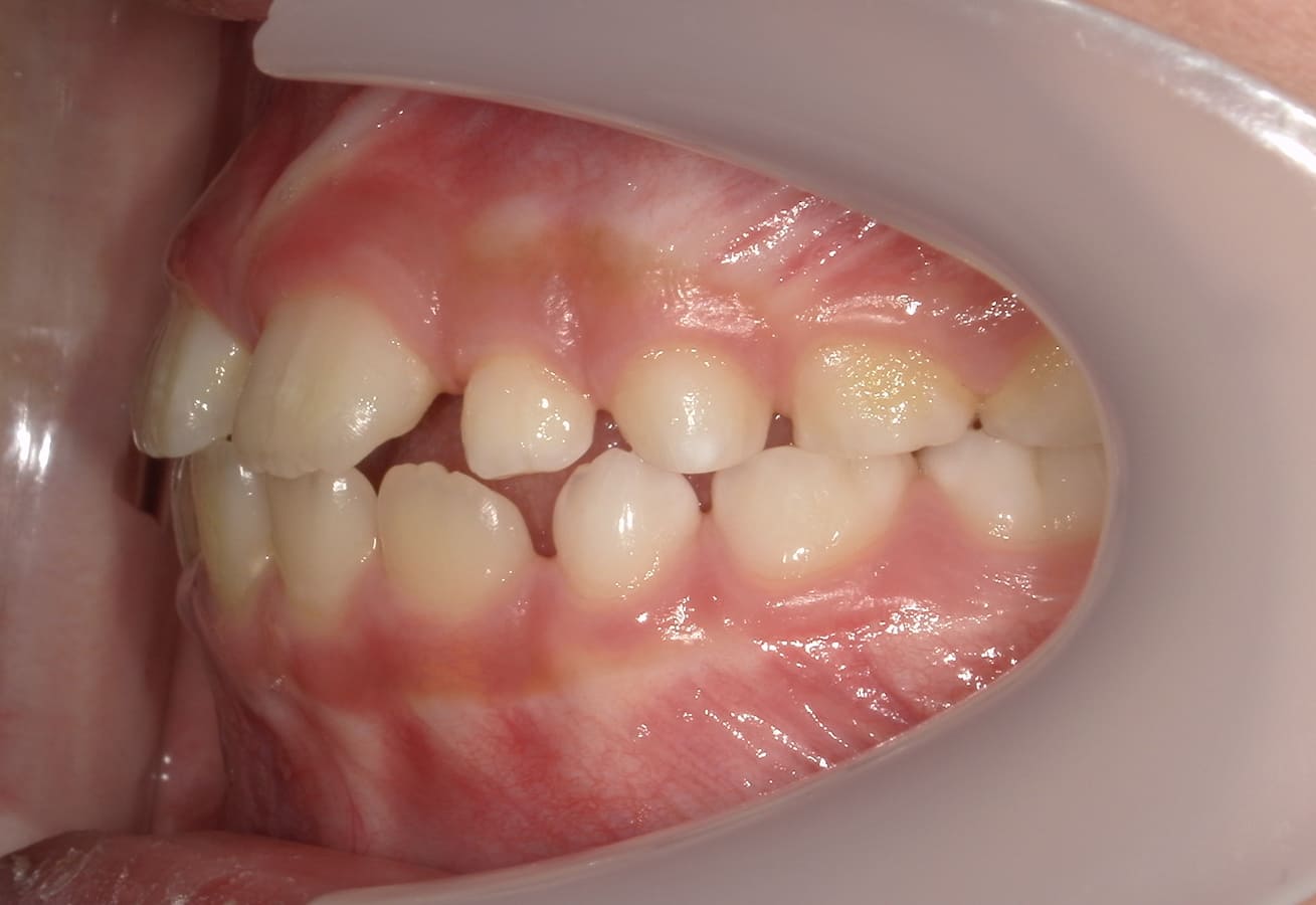 施術前の口内写真03
