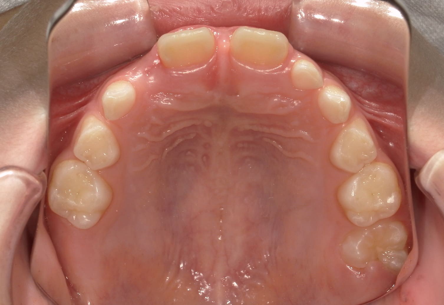 施術前の口内写真04